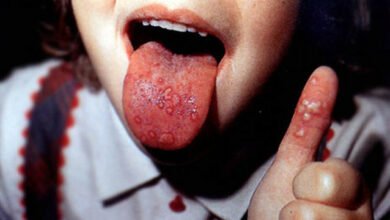 Confirman siete casos de Coxsackie en Morelia, Michoacán