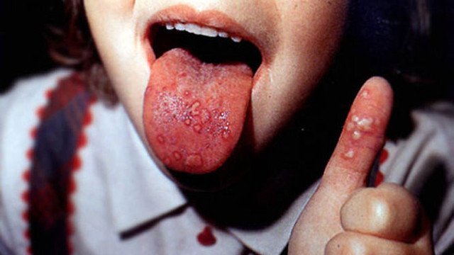 Confirman siete casos de Coxsackie en Morelia, Michoacán