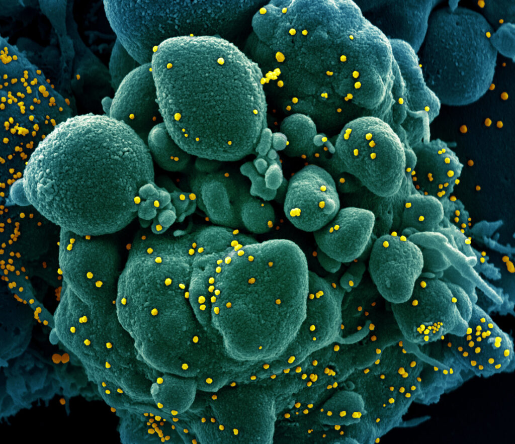 FOTOS: Captan al coronavirus atacando células humanas