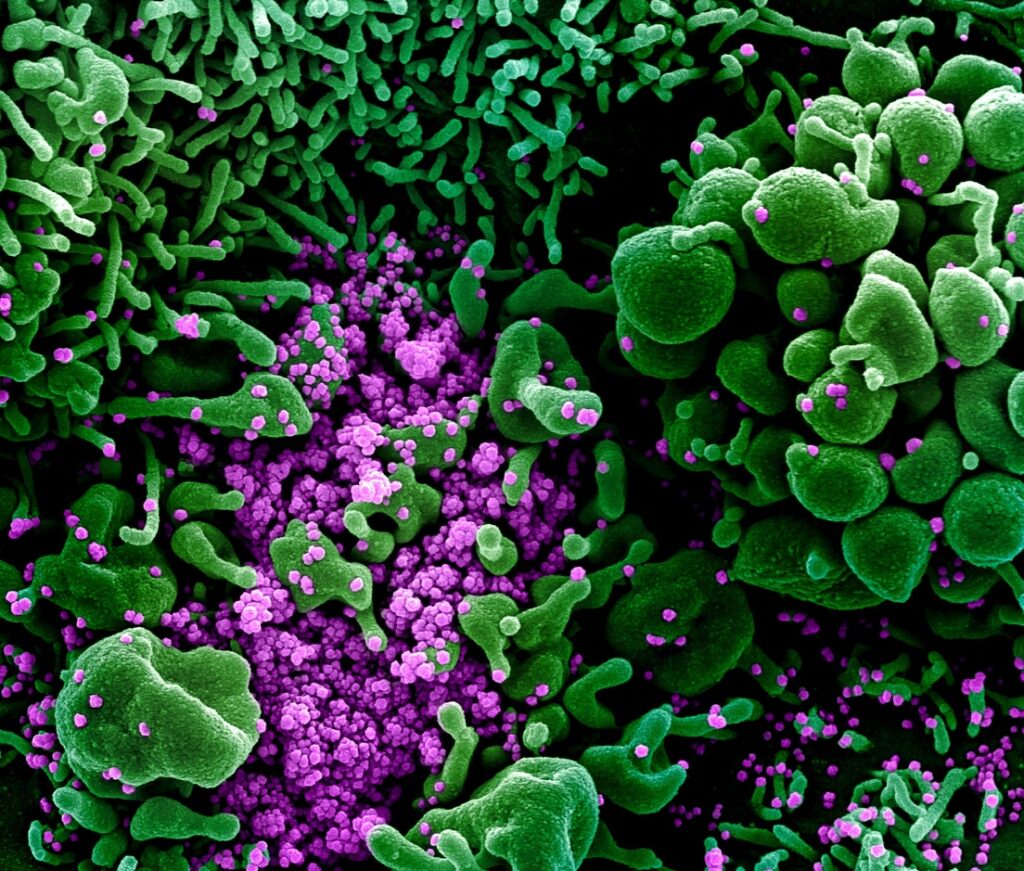 FOTOS: Captan al coronavirus atacando células humanas